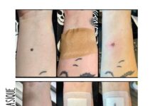 L’horreur au service de la prévention : le projet de l’artiste Charlotte Pimentel face au cancer de la peau